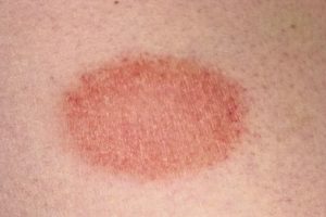 ring work disease