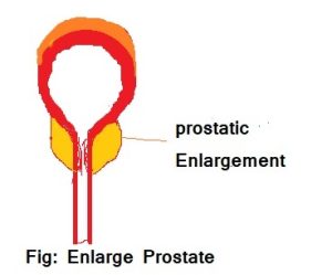 Enlarge Prostate