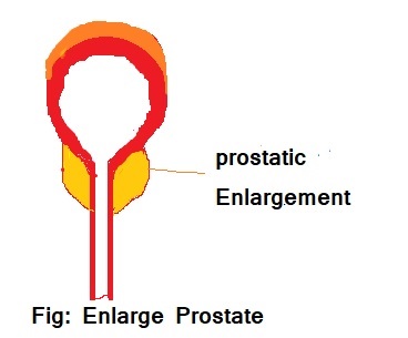 prostatic enlargement